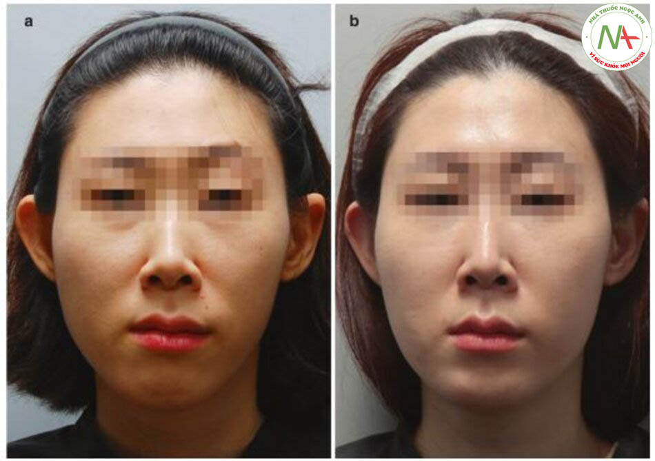 Hình 4.126 Đánh giá trước điều trị về sự bất đối xứng trên khuôn mặt ((a) Trước, (b) sau khi điều trị bằng cách sử dụng chất làm đầy và độc tố botulinum và (c) chiến lược đánh giá và điều trị cho sự bất đối xứng trên khuôn mặt).