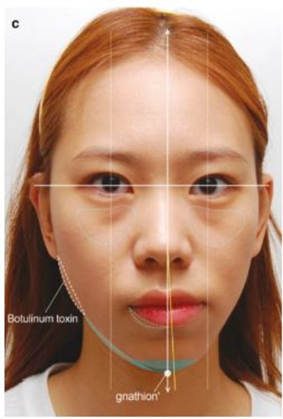 Hình 4.127 Kỹ thuật tiêm để chỉnh sửa sự bất đối xứng trên khuôn mặt bằng cách sử dụng chất làm đầy và độc tố botulinum ((a) Trước, (b) sau khi điều trị, (c) chiến lược đánh giá và điều trị cho sự bất đối xứng trên khuôn mặt).