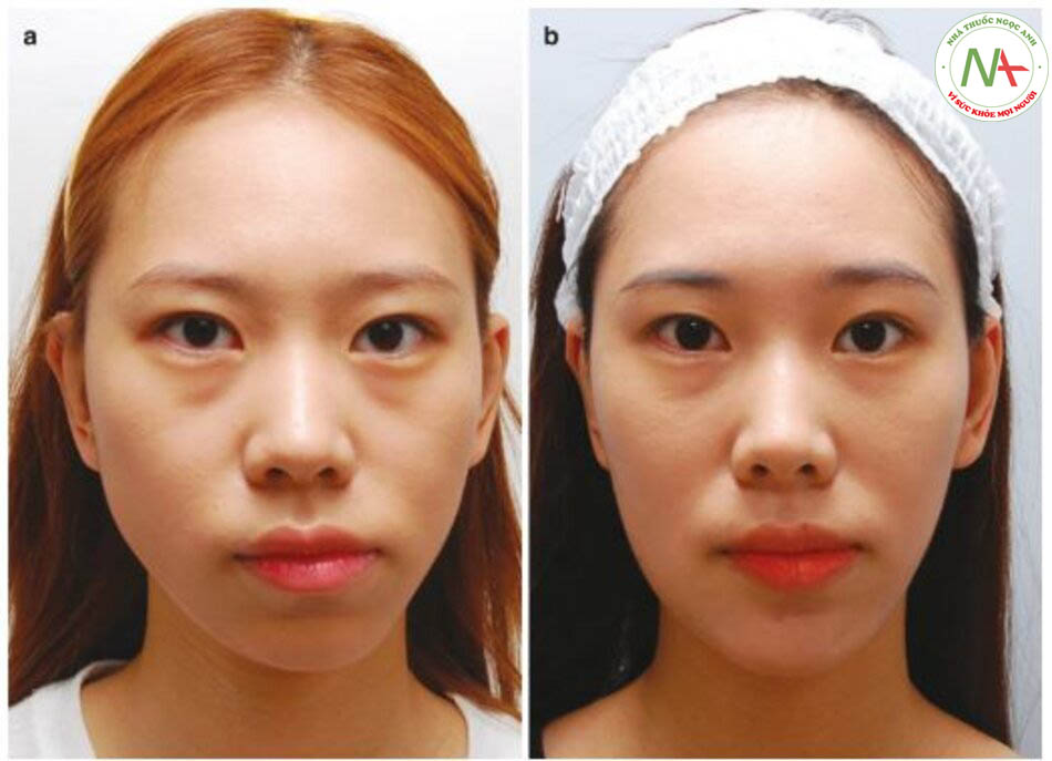 Hình 4.127 Kỹ thuật tiêm để chỉnh sửa sự bất đối xứng trên khuôn mặt bằng cách sử dụng chất làm đầy và độc tố botulinum ((a) Trước, (b) sau khi điều trị, (c) chiến lược đánh giá và điều trị cho sự bất đối xứng trên khuôn mặt).