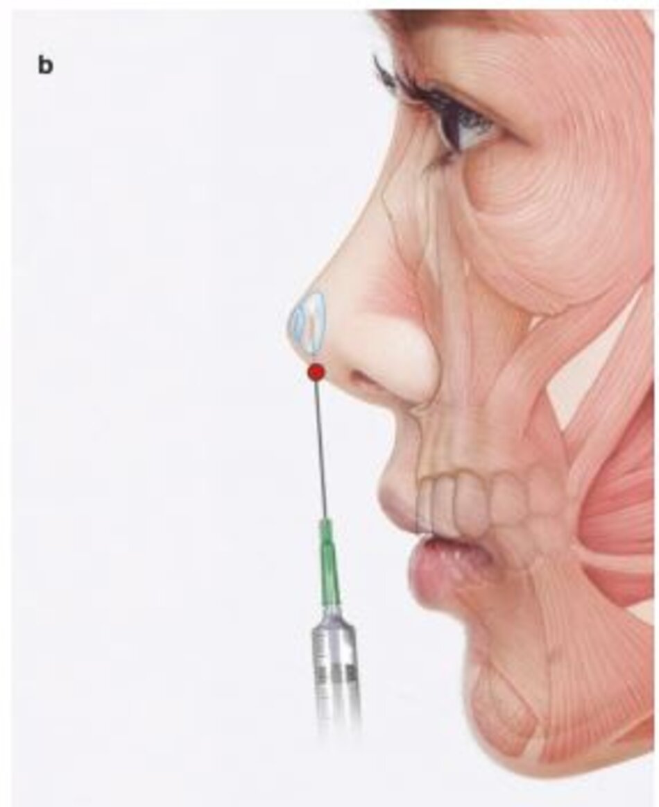 Hình 4.61 (a) Điểm vào ống thông để chỉnh sửa đỉnh mũi. (b) Độ sâu của mũi tiêm để chỉnh sửa đỉnh mũi.