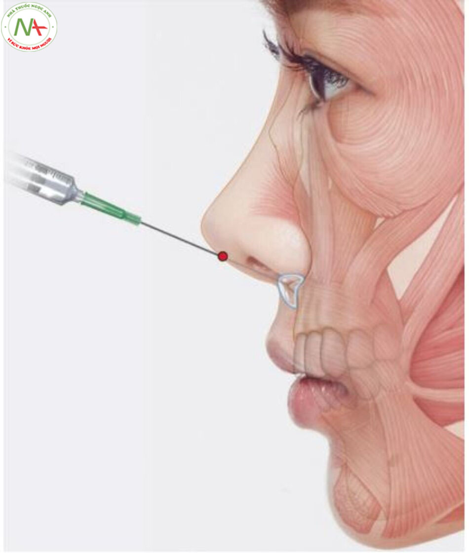 Hình. 4.63 Độ sâu tiêm để chỉnh sửa góc mũi môi.