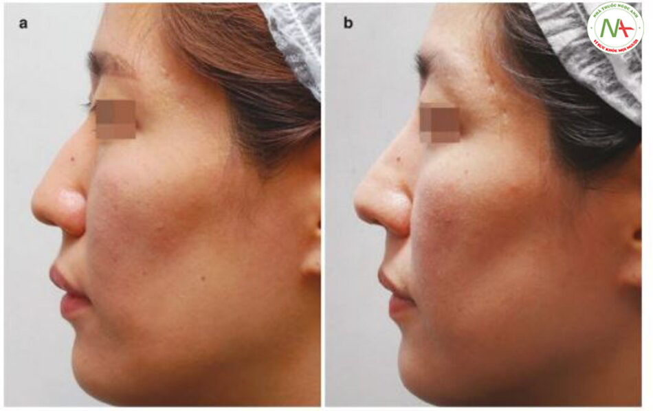 Hình 4.65 (a) Trước và (b) sau khi chỉnh sửa mũi gồ. (Nâng sống mũi kết hợp với nâng góc mũi - môi).
