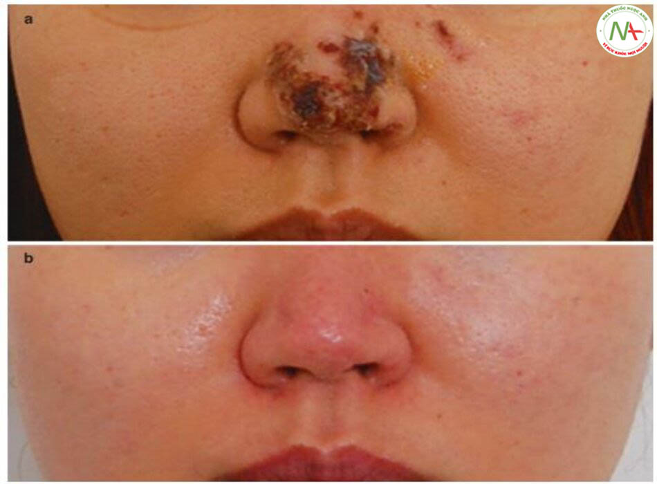 Hình 4.73 (a) Các mụn mủ có thể tiến triển thành hoại tử da với sự hình thành lớp vảy trong trường hợp nghiêm trọng. (b) Cải thiện sau 6 tháng sau khi tiêm PRP và chiết xuất nhau thai kết hợp với điều trị laser phân đoạn và làm sáng da bằng laser NdYAG