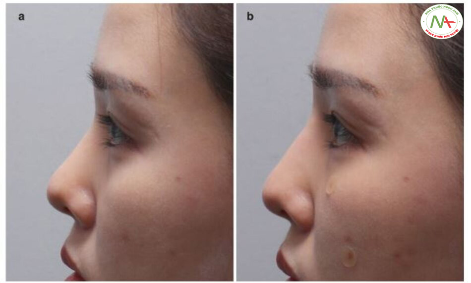 Hình 4.57 (a) Trước và (b) sau khi nâng sốngmũi (c) Hình ảnh chồng chéo của sống mũi trước và sau khi nâng thể hiện rõ ràng phần sống mũi được nâng cao lên.