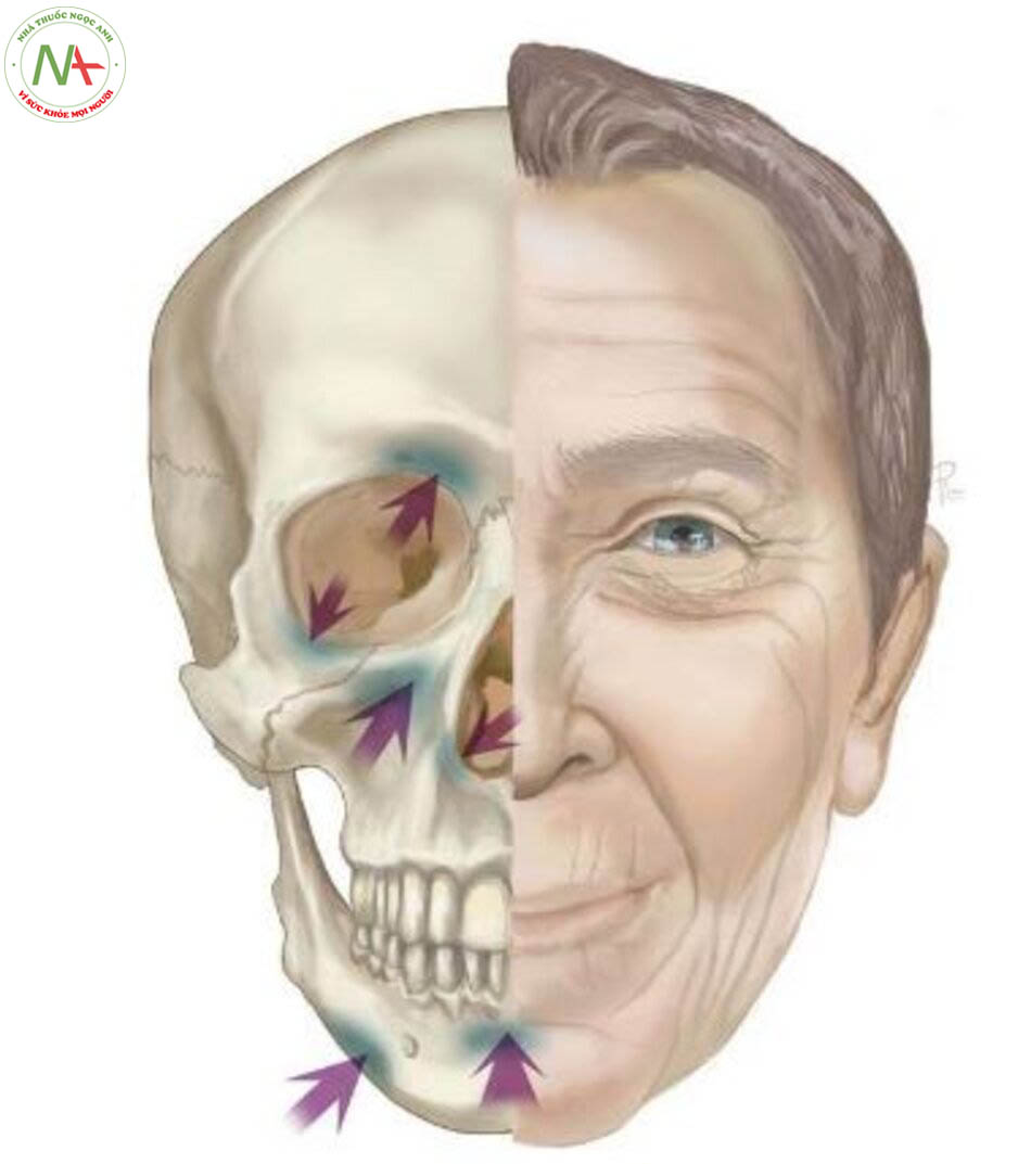 Hình 2.2 Thay đổi trong khung xương mặt do lão hóa. Mũi tên chỉ các vùng dễ bị thoái hóa do lão hóa (Mendelson và Vương [25])
