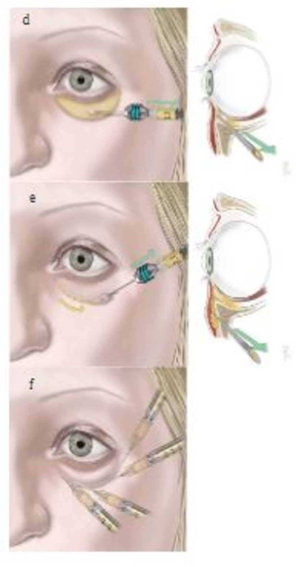 Hình. 8.6 Phẫu thuật tạo hình mi mắt và ghép mỡ. (a) Dạng lão hóa mí dưới hay gặp. (b) Giải phóng cung bờ mi sẽ giúp cải thiện da sẫm mà bên du-wois mắt. (c) Lấy mỡ qua kết mạc mi mắt. (d) Tiêm nhũ tương từ bờ ổ mắt hướng đến vùng mí mắt. (e) Tiêm microfat trong vùng bờ ổ mắt và vùng má để cải thiện da ở những vùng này. (f) Tiêm nanofat hay SNIE để cải thiện màu sắc da của mi mắt dưới.