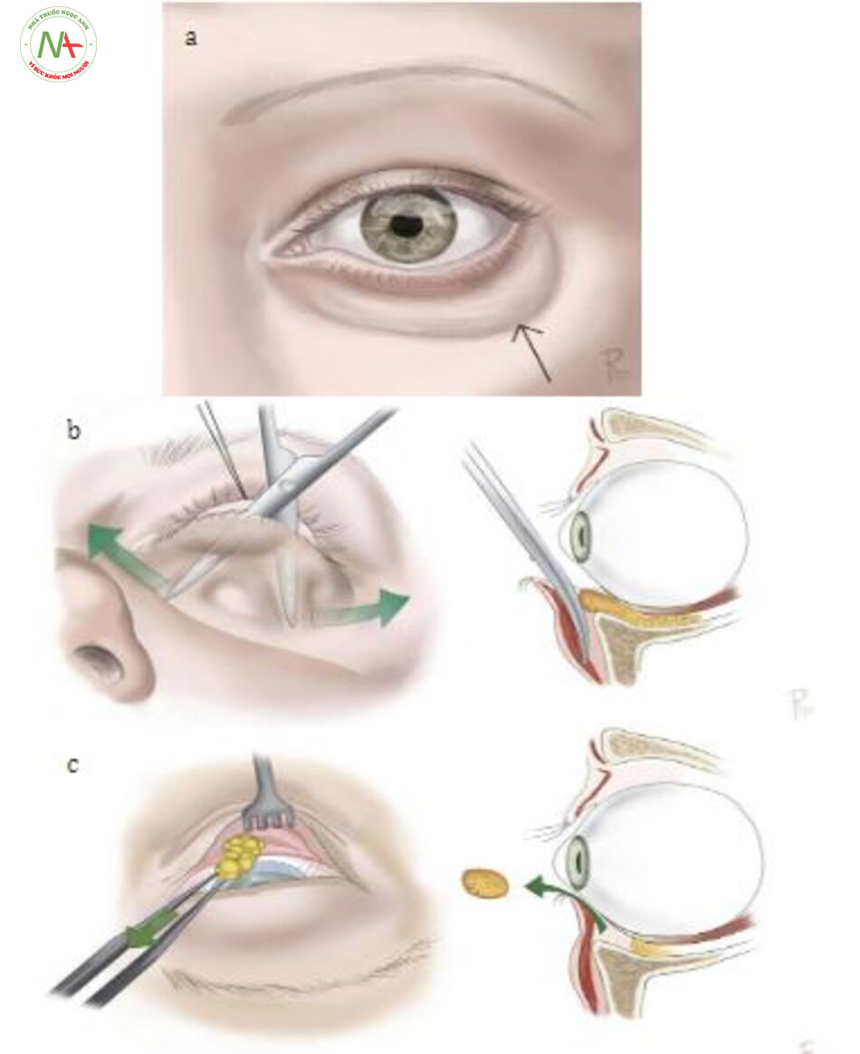 Hình. 8.6 Phẫu thuật tạo hình mi mắt và ghép mỡ. (a) Dạng lão hóa mí dưới hay gặp. (b) Giải phóng cung bờ mi sẽ giúp cải thiện da sẫm mà bên du-wois mắt. (c) Lấy mỡ qua kết mạc mi mắt. (d) Tiêm nhũ tương từ bờ ổ mắt hướng đến vùng mí mắt. (e) Tiêm microfat trong vùng bờ ổ mắt và vùng má để cải thiện da ở những vùng này. (f) Tiêm nanofat hay SNIE để cải thiện màu sắc da của mi mắt dưới.