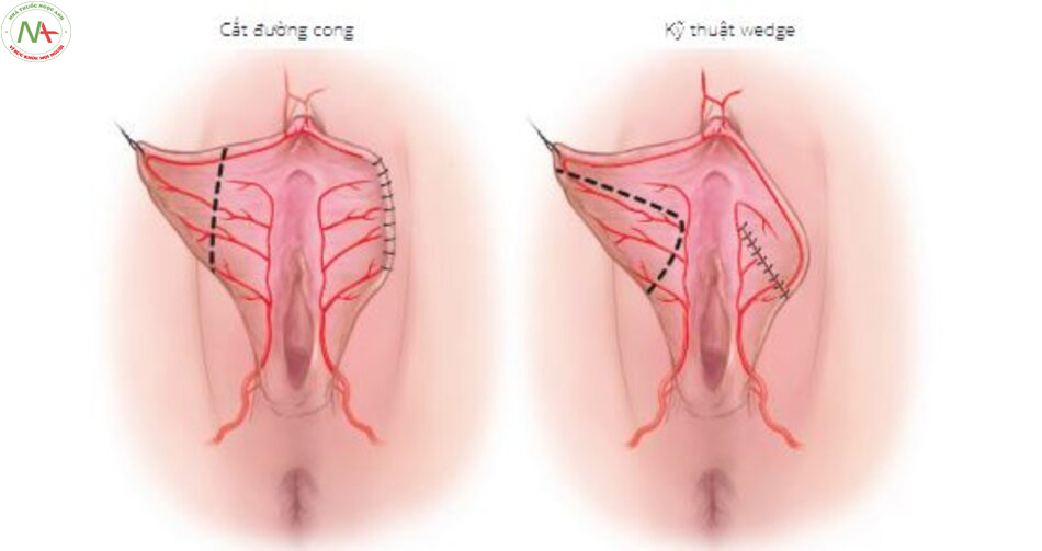 Hình. 1-9 Sơ đồ cấp máu vùng môi âm hộ trong hai kỹ thuật wedge và tạo hình đường cong 