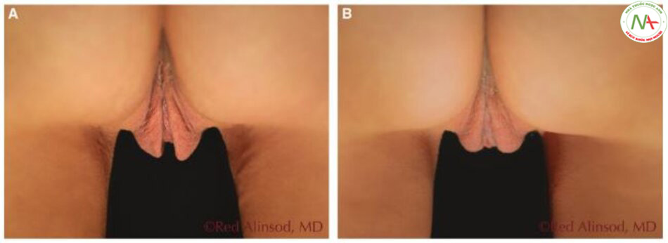 Hình. 6-5 Bệnh nhân này đã được thực hiện phẫu thuật giảm môi lớn (to và thừa da), với một ‘ngoại hình’ ‘trẻ trung’ hơn khi nhìn từ phía sau. A: Hình ảnh trước phẫu thuật và B: Hình ảnh sau phẫu thuật 2 tháng.