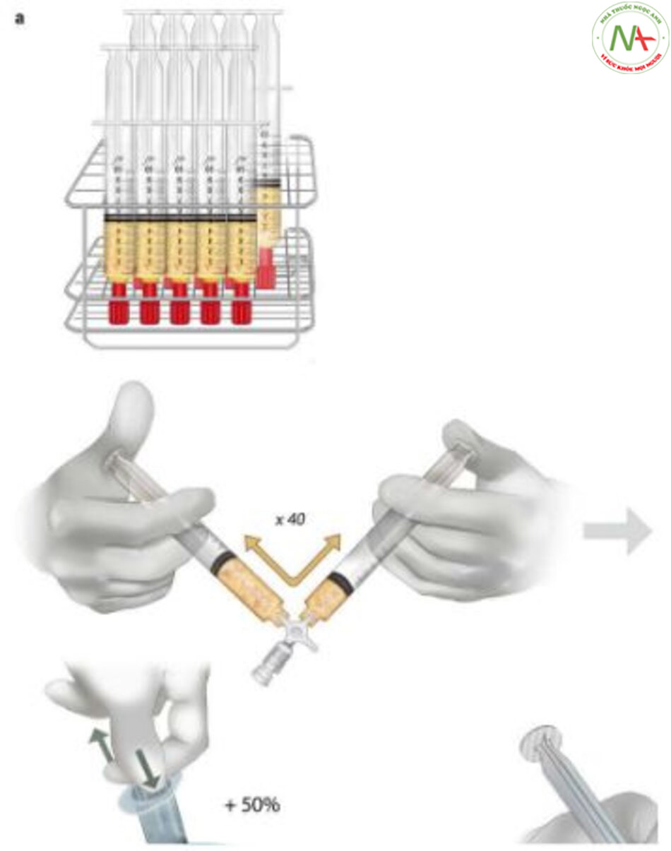 Hình 6.11 Nhũ tương hoặc mỡ phân đoạn. (a) Cơ chế nhũ tương của mảnh ghép microfat được làm từ hai ống tiêm và sau đó rửa sạch và gạn mỡ. (b) Có thể thực hiện tiêm ghép mỡ bằng ống cannula (nhũ tương hoặc mỡ phân đoạn) hoặc ống syringe (SNIE, tiêm nhũ tương vào trong da bằng kim nhọn)