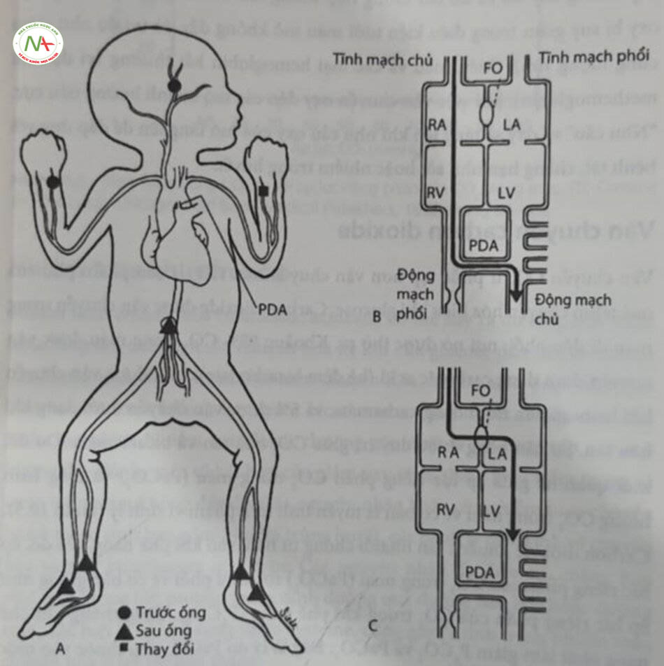 Hình 10.4 Shunt của máu trong tâng áp động mạch phổi. (A) Địa điểm láy mấu. (B) Shunt từ phải sang trái qua óng động mạch. (C) Shunt từ phải sang trái qua lố bàu dục. (C) lỗ bầu dục; LA, tâm nhĩ trái; LV, tâm thất trái; PDA, ống động mạch; RA, tâm nhĩ phải; RV, tâm thất phải