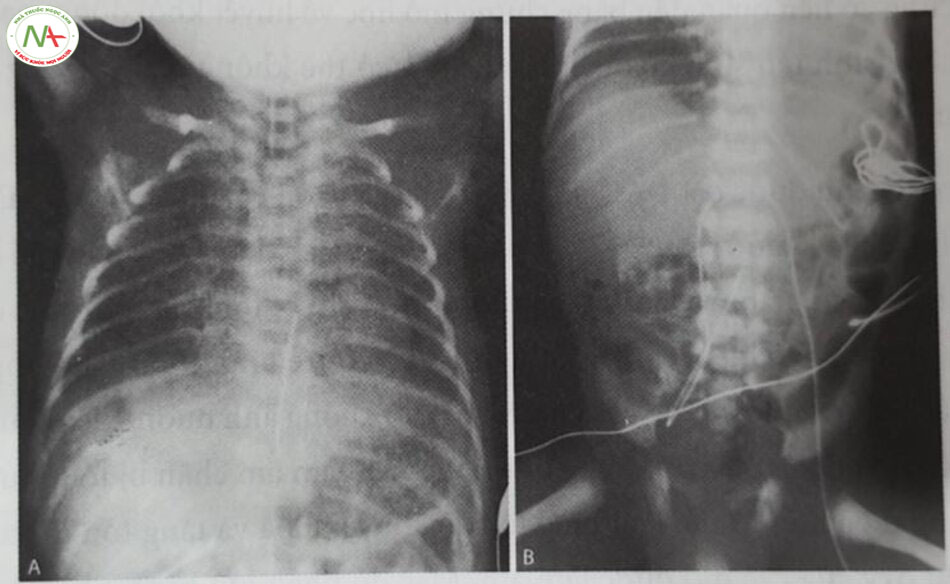 Hình 10.7 (A) Ảnh chụp X-quang cho thấy ống thông động mạch rỗn ỏ vị trí "cao". (B) Ảnh chụp X-quang cho thấy óng thông động mạch rốn ỏ vị trí "thắp". 