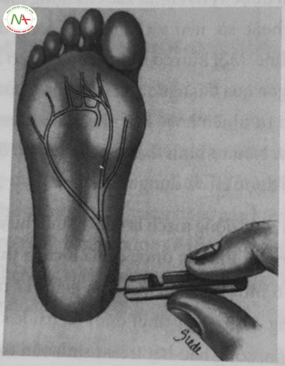 Hình 10.9 Kỹ thuật lây mâu máu gót chân mao mạch động mạch hóa. Phàn vẽ bằng các chắm nhỏ biểu thị các khu vực chính xác để lấy mẩu.