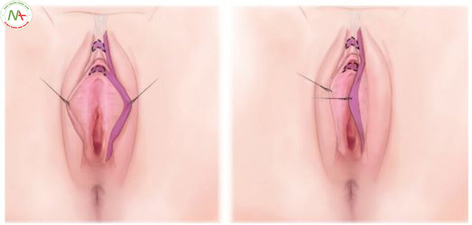 Hình 7-10 Phẫu thuật CHR sửa đổi, được mô tả bởi BS Gress, như 1 bước trong phẫu thuật giảm môi âm hộ