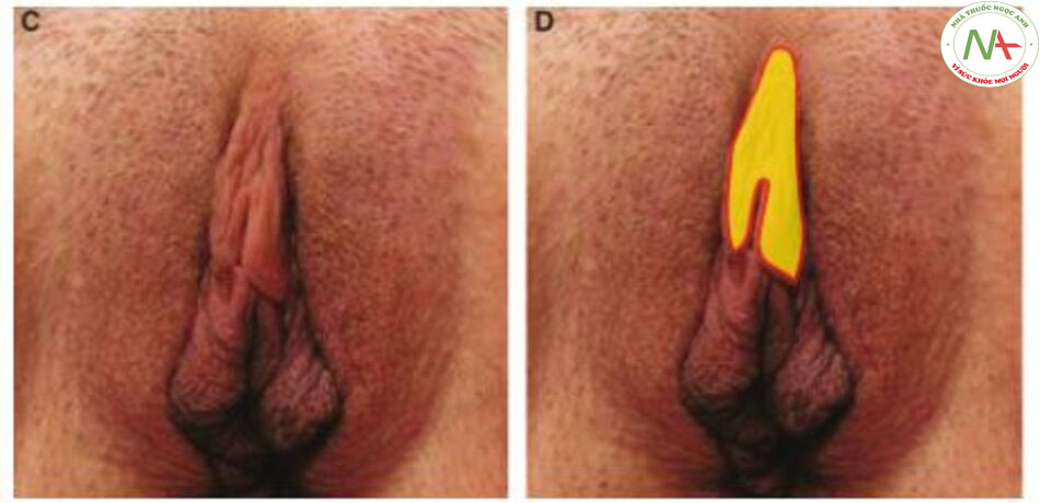 Hình. 7-1, (tiếp) C, Cũng bệnh nhân đó nhưng trước phẫu thuật tạo hình mũ âm vật. D, Khu vực được đánh dấu là vùng thực hiện thủ thuật CHR