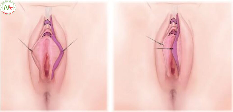 Hình 7-7: CHR được mô tả bởi Gress như 1 bước trong phẫu thuật giảm môi âm hộ.