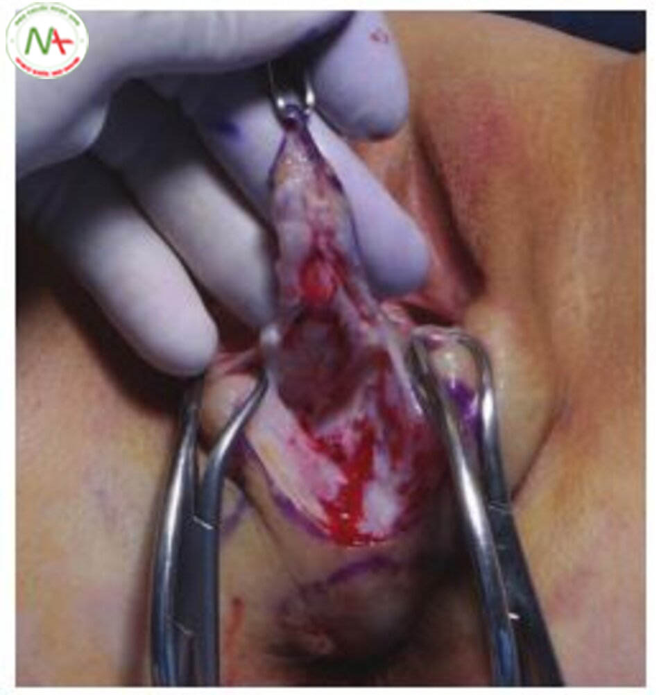 Hình. 11-4 Tiếp cận khoang trực tràng âm đạo. Bóc tách lớp dưới da dọc theo thành âm đạo, tạo áp lực ngược hướng bằng tay không thuận để hỗ trợ bóc tách tới ngang với lỗ màng trinh.