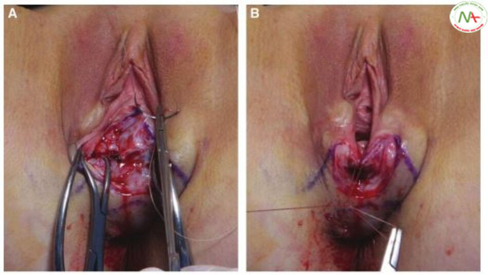 Hình. 11-6 A, Sau khi cắt bỏ vạt âm đạo, vết rạch âm đạo được đóng lại bắt đầu từ đỉnh bằng mối vắt thưa. B, Vết mổ đóng âm đạo kết thúc ở lỗ màng trinh.
