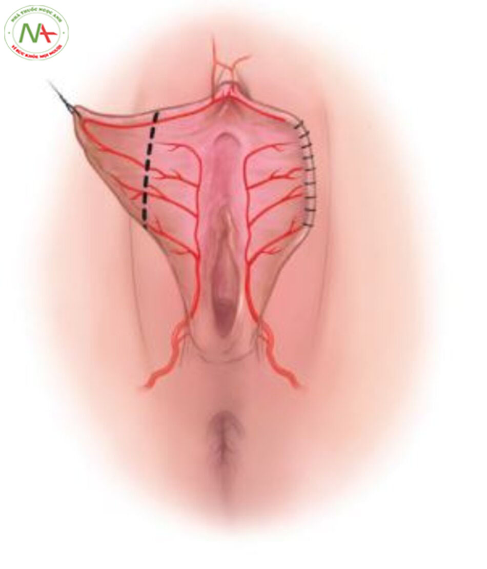 Hình. 4-16 Đường rạch trong kỹ thuật tạo hình bờ tự do môi âm hộ giúp bảo tồn mạch máu chính.