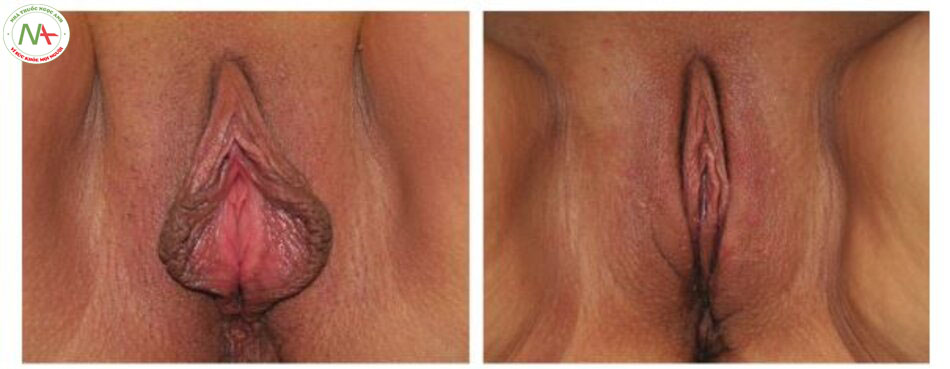 Hình. 4-3 Bệnh nhân nữ 49 tuổi với hình ảnh trước phẫu thuật (trái) và sau phẫu thuật wedge 3 tháng.