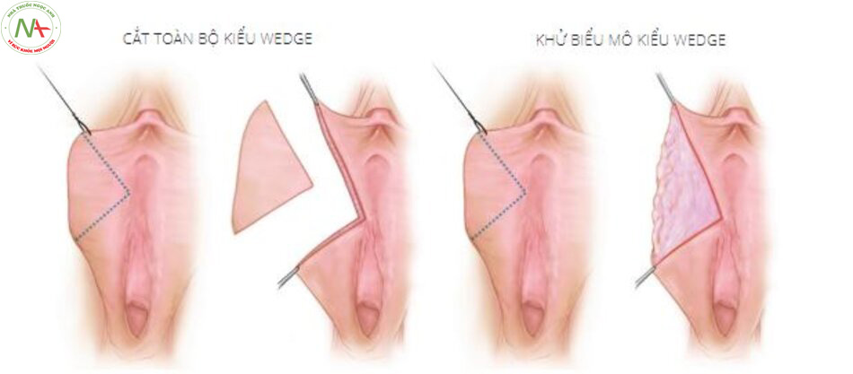 Hình. 4-6 Bệnh nhân nữ 44 tuổi với môi âm hộ mỏng, và teo đét (hạ niêm mạc tối thiểu) với hình ảnh trước và sau thực hiện cắt kiểu wedge hình chữ L và bảo tồn lớp hạ niêm mạc (chỉ khử biểu mô).