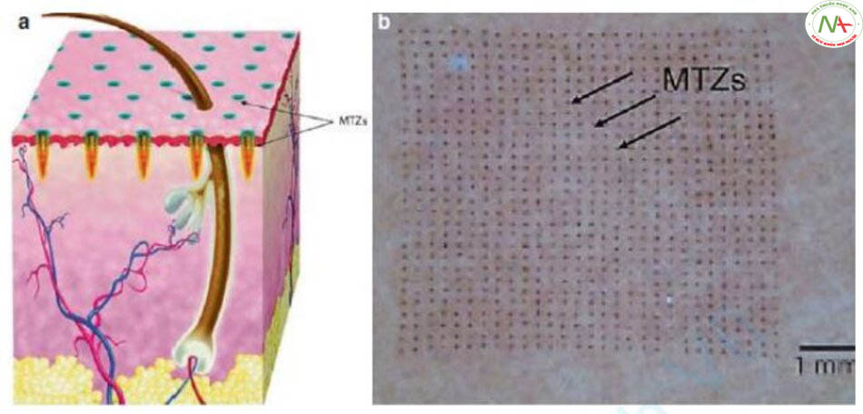 Hình 7.1 (a) Hình vẽ của quang nhiệt phân đoạn (fractional photothermolysis, FP) mô tả các MTZ được bao quanh bởi các mô không bị tổn thương. (b) Hình ảnh lâm sàng các MTZ được bao quanh bởi các mô không bị tổn thương.