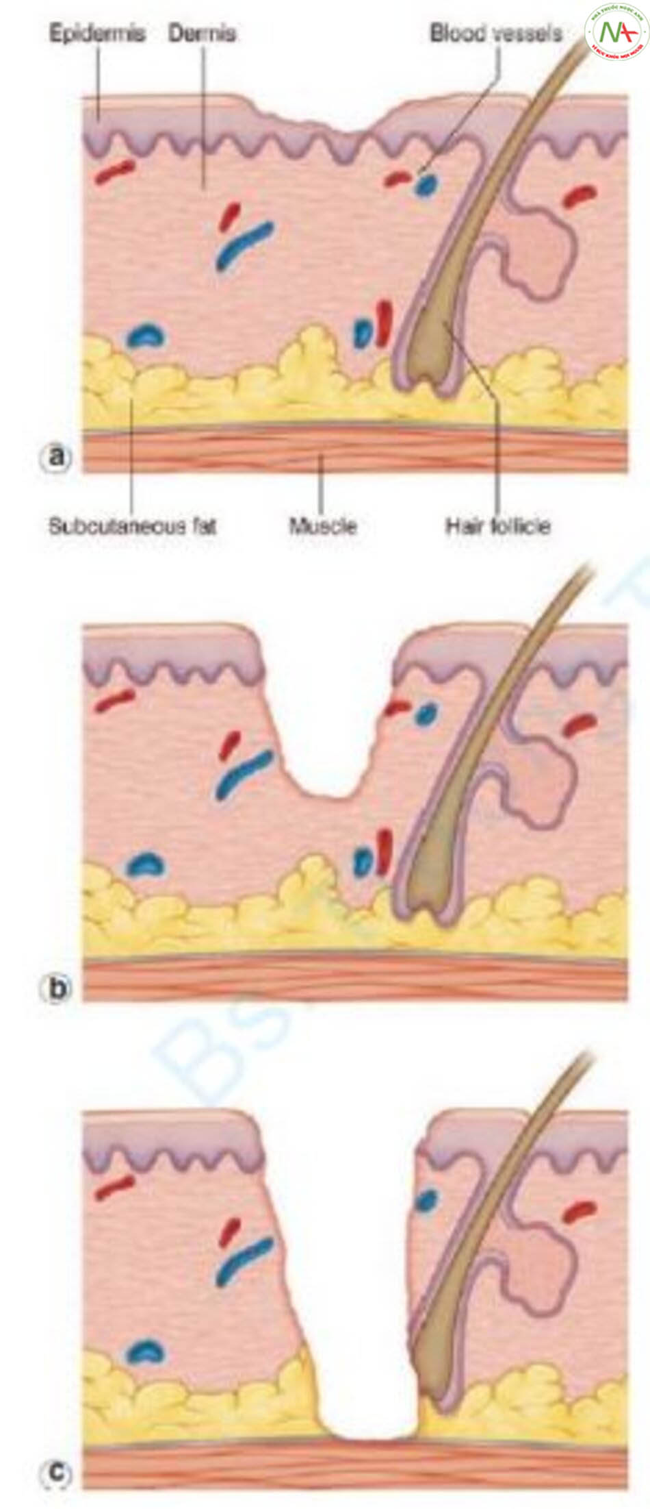 Hình 7.3 So sánh các vết thương do trợt, một phần độ dày và toàn độ dày da. (a) Trợt: chỉ mất lớp biểu bì. (b) Vết thương một phần độ dày: thiếu lớp biểu bì và một phần của lớp bì nhưng vẫn còn một số cấu trúc phụ. (c) Vết thương toàn độ dày da: thiếu tất cả lớp biểu bì và lớp bì cùng với các cấu trúc phần phụ. Da mất toàn bộ độ dày ảnh hưởng đến mô mỡ dưới da và có thể kéo dài xuống nhưng không xuyên qua lớp cơ bên dưới.
