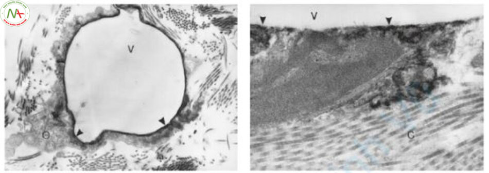 Hình 7.7 (a) Hình ảnh dưới kính hiển vi điện tử ngay sau khi điều trị bằng laser. Không bào nội bào lớn (V) là một đường với sắc tố còn sót lại và các thành phần tế bào bị nén (mũi tên). Các bào quan khác trong tế bào chất (O) biểu hiện nguyên vẹn. (Uranyl axetat và chì xitrat, x 11.000). (b) Sắc tố còn sót lại (mũi tên) dọc theo mép của không bào (V). Chất nhiễm sắc trong nhân dường như không bị hư hại. Các sợi collagen (C) tiếp giáp với không bào cho thấy cấu trúc và dải bình thường.