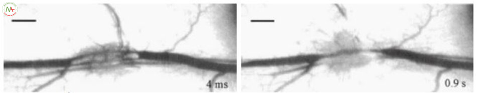 Hình 6.12 Chiếu tia với bước sóng 1064 nm, 25 ms, 400 J/cm2. Khoang trong mạch phá hủy thành mạch (a) dẫn đến xuất huyết (b)