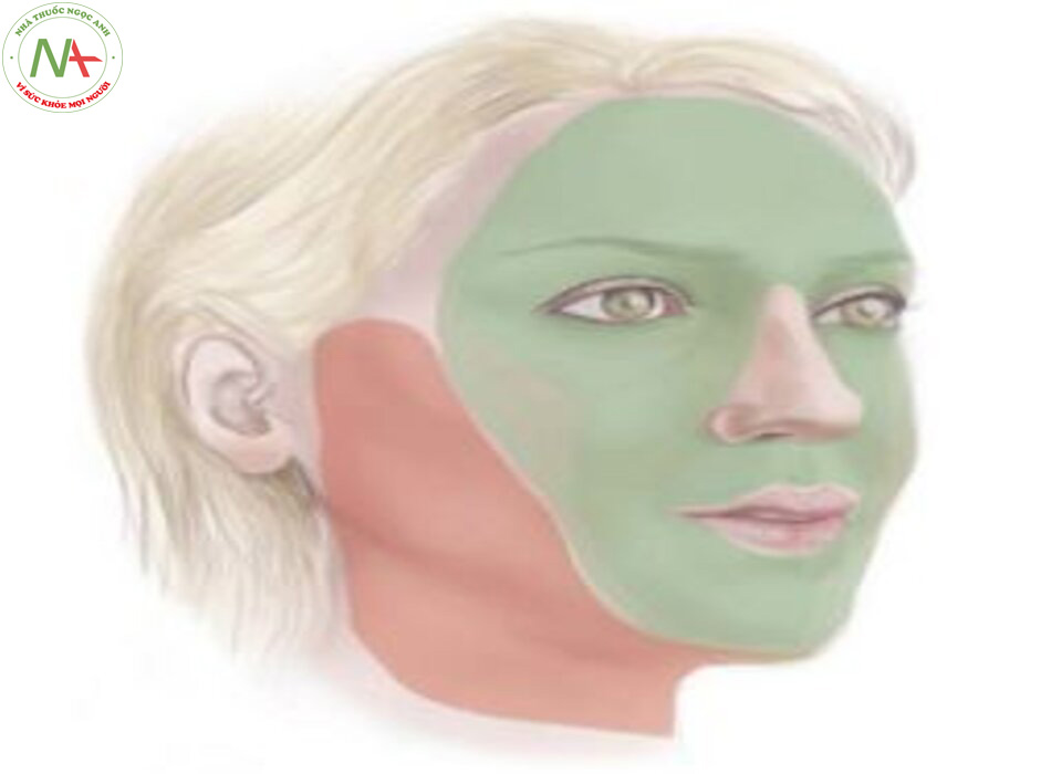 Hình 1.1 Các kỹ thuật trẻ hóa da mặt và cổ không chỉ điều chỉnh độ chảy xệ ở các vùng ngoại vi của khuôn mặt bằng kỹ thuật căng da mặt (màu đỏ) mà còn để tăng khối lượng mỡ teo đi và phân bố lại mỡ ở trung tâm các vùng của khuôn mặt (màu xanh lá cây)