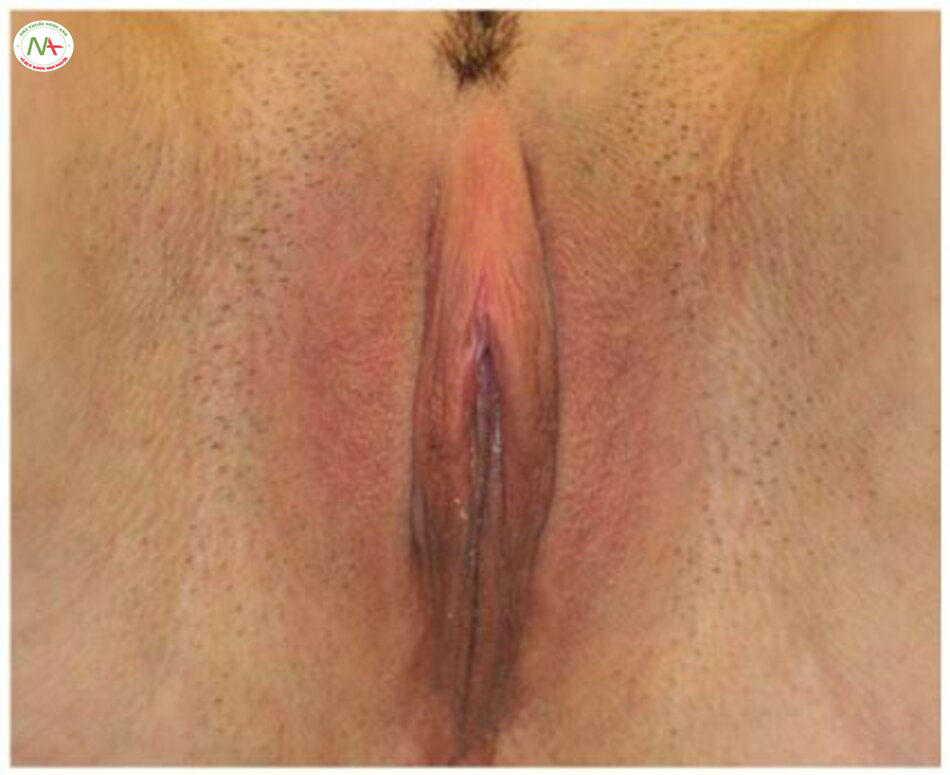 Hình. 10-15 Bệnh nhân nữ 30 tuổi với hình ảnh coin slot sau khi được phẫu thuật tạo hình môi kiểu wedge, mũ âm vật bị kéo về phía sau.