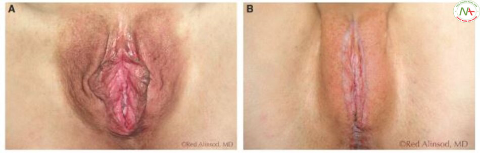 Hình. 10-19 A Hình ảnh trước phẫu thuật giảm môi lớn. B, Sau phẫu thuật xuất hiện sẹo.