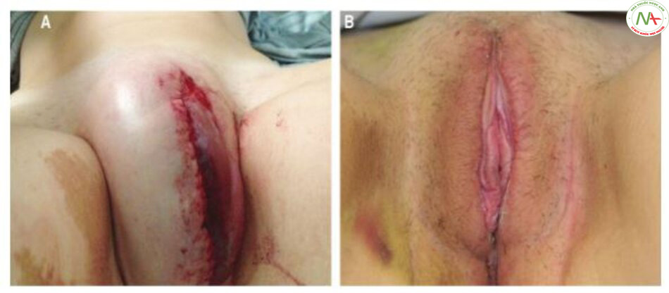 Hình. 10-8 A, BN nữ 24 tuổi này xuất hiện khối máu tụ lớn sau 8 giờ phẫu thuật giảm môi lớn. B, Hai tuần sau khi dẫn lưu khối máu tụ lớn.
