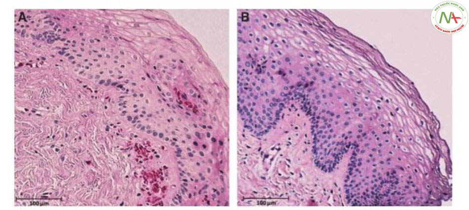 Hình. 17-2 Tiêu bản nhuộn Hematoxylin và eosin của tế bào thành âm đạo. A, Hình ảnh trước khi điều trị. B, Bảy ngày sau khi điều trị, kiến trúc niêm mạc được cải thiện, bao gồm cả lớp biểu mô và lớp đệm.