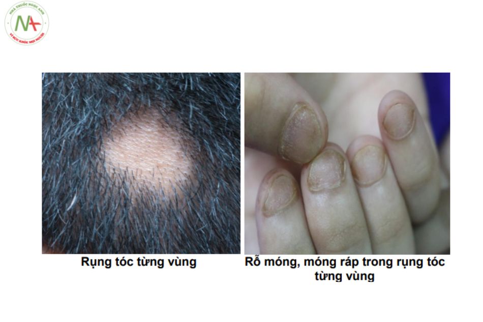 Rụng tóc từng vùng (alopecia areata)