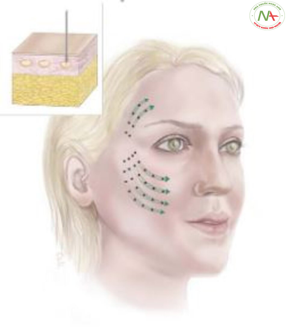 Hình. 15.2 Ví dụ vị trí hay sử dụng để tiêm meso nhất ở vùng mặt