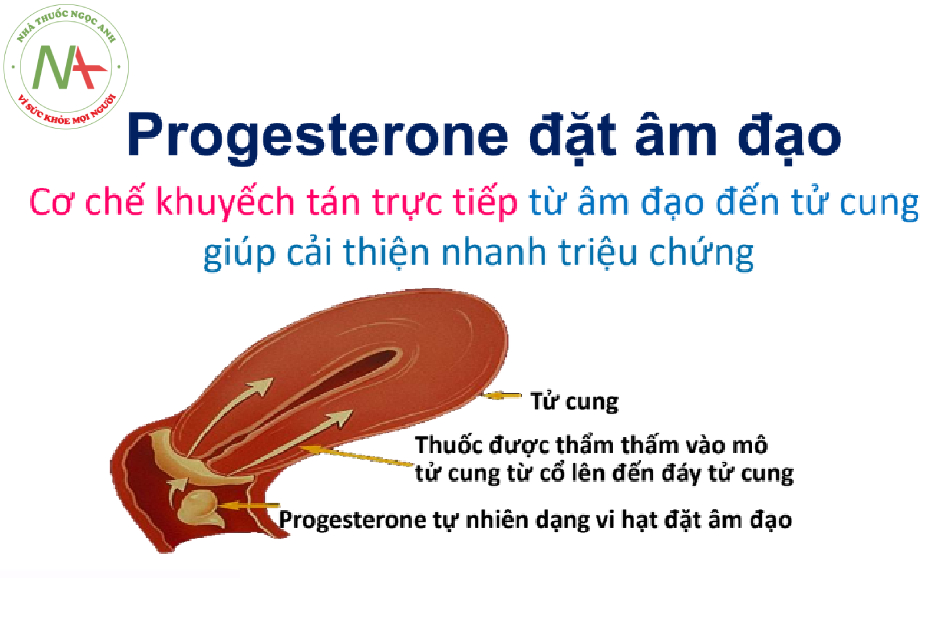 Progesterone đặt âm đạo