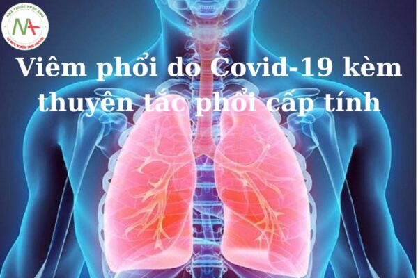 Viêm phổi do Covid-19 kèm thuyên tắc phổi cấp tính