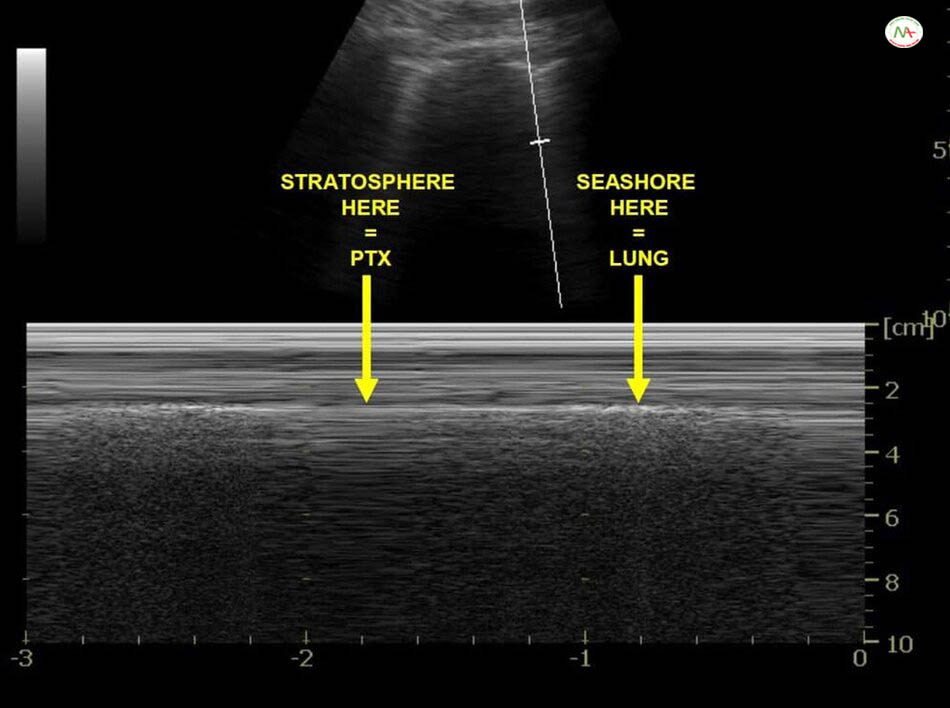 Dấu hiệu điểm phổi (Lung point) trên M-Mode: cho thấy khu vực có dấu hiệu tầng bình lưu (Stratosphere sign) hay dấu hiệu mã vạch (Barcode sign) tràn khí nối tiếp với dấu hiệu bờ biển (Seashore sign) bình thường. Giúp chẩn đoán tràn khí màng phổi.