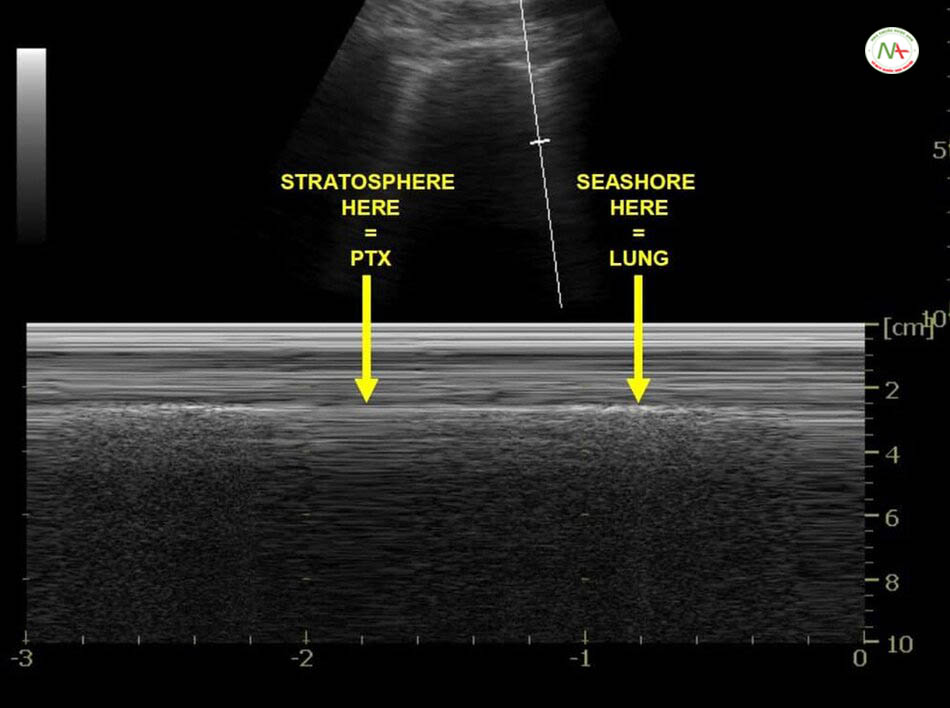 Dấu hiệu điểm phổi (Lung point) trên M-Mode: cho thấy khu vực có tầng bình lưu (Stratosphere) hay dấu hiệu mã vạch (Barcode) tràn khí nối tiếp với dấu hiệu bờ biển (Seashore) bình thường. Giúp chẩn đoán tràn khí màng phổi.