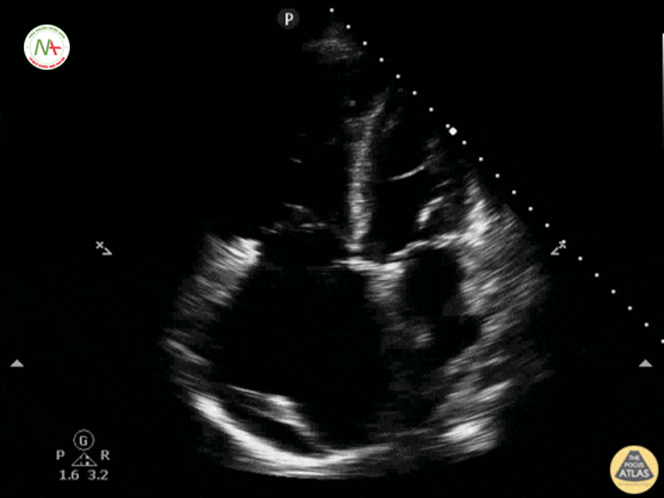 Giãn thất phải (RV) trên mặt cắt 4 buồng ở mỏm tim