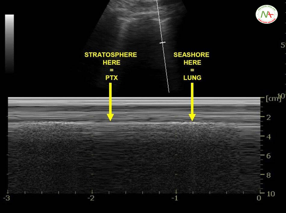 Dấu hiệu điểm phổi (Lung point) trên M-Mode: cho thấy khu vực có dấu hiệu tầng bình lưu (Stratosphere sign) hay dấu hiệu mã vạch (Barcode sign) tràn khí nối tiếp với dấu hiệu bờ biển (Seashore sign) bình thường. Giúp chẩn đoán tràn khí màng phổi.
