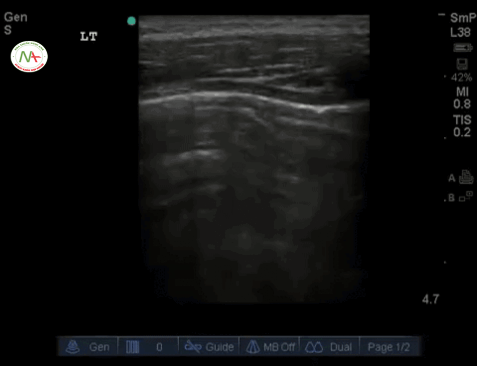 Phổi trượt (Lung sliding) hay trượt màng phổi trên siêu âm 2D với đầu dò Linear