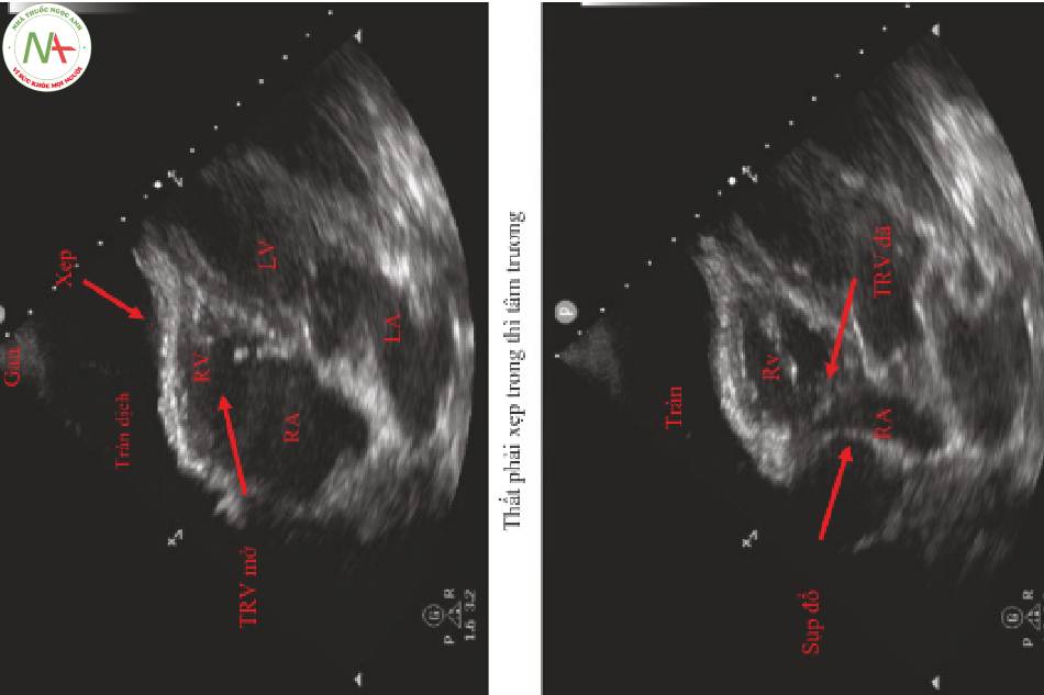 Hình 1 Phát hiện siêu âm tim trong chèn ép tim. Hình trên_ thất phải xẹp thì tâm trương.