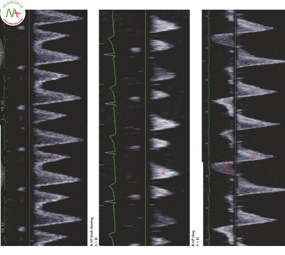 Hình 2 Dòng chảy tĩnh mạch gan thay đổi với sự gia tăng áp lực nhĩphải. Hình phía trên: RAP bình thường, S > D và cả hai đều nằm trên đường cơ sở. Trên tracing này, không thể nhìn thấy QRS, nhưng sóng a dễ dàng được xác định. Hình giữa: RAP tăng. QRS có thể được nhìn thấy. S là sóng đi ngay sau QRS. D nằm sau S và rơi sau T. Hình dưới: RAP cao với dòng chảy ngược trong tâm thu. Cả a và S đều nằm trên đường cơ sở. Sóng D nằm dưới đường cơ sở