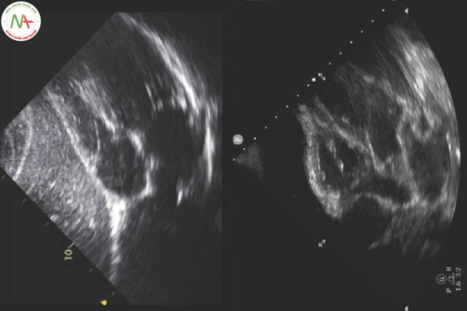 Hình 2 Tràn dịch màng ngoài tim với chèn ép. Hình trên_ RV bình thường không tràn dịch. Hình dưới_ tràn dịch màng ngoài tim lượng nhiều có khả năng gây chèn ép tim