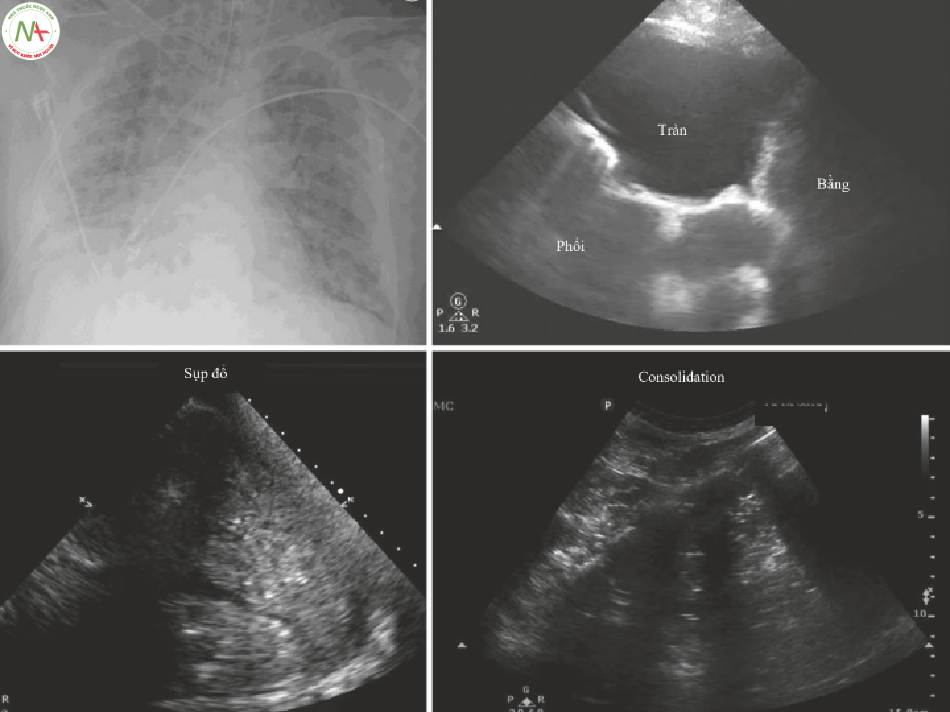 Hình 3 Tràn dịch màng phổi, xẹp và đông đặc phổi. Phía trên bên trái_ Chụp X-quang ngực cổ điển ở bệnh nhân bị bệnh nặng.
