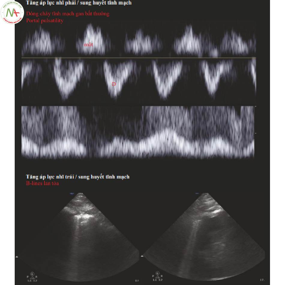 Hình 3 Trường hợp 2_ Sung huyết tĩnh mạch nặng Lưu lượng tĩnh mạch gan bất thường.
