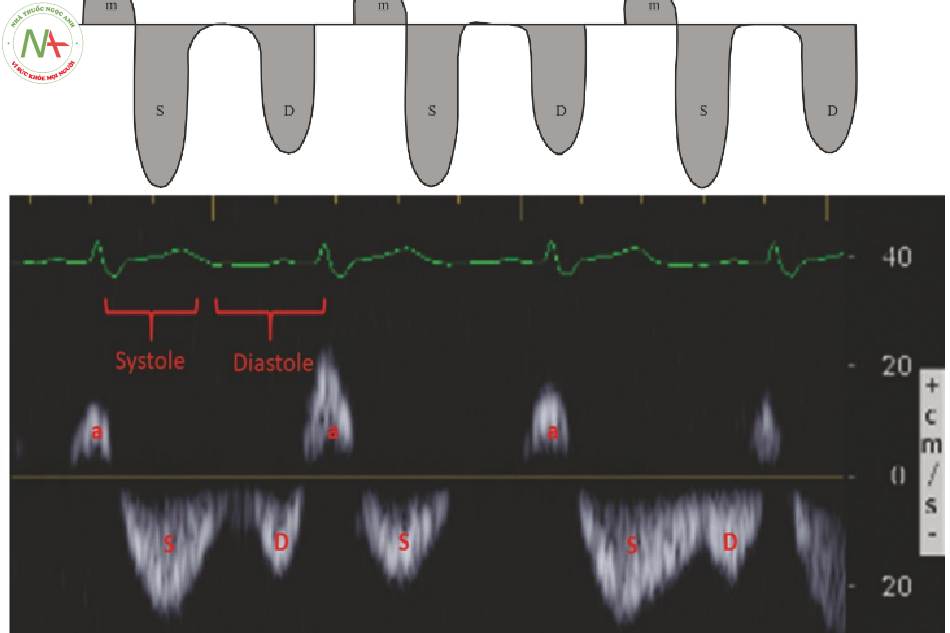 Hình 3 Xác định sóng co thắt tâm nhĩ (a), tâm thu (S) và tâm trương (D) của tĩnh mạch gan