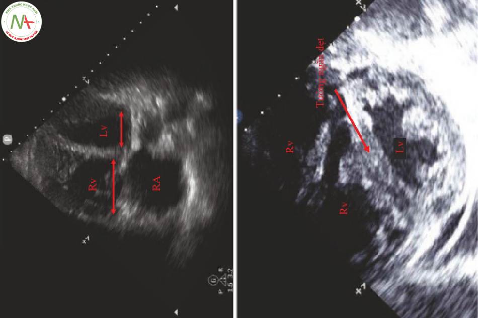 Hình 4 Dấu hiệu siêu âm tim trong thuyên tắc phổi. Hình phía trên; RV lớn..